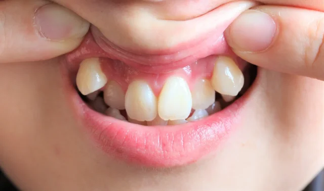 インビザライン Goプラスで対応できる歯並びと対応できない歯並び