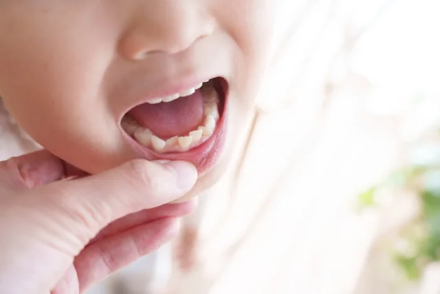 子供の矯正方法は年齢と歯の生え変わりでどう変わる？