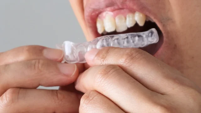 矯正で見た目変化が出やすい歯の部位と動きが見えにくい部位の違いは？