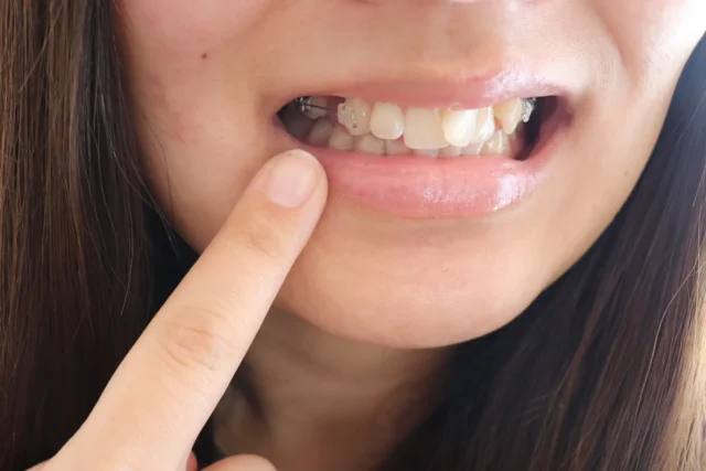インビザラインが苦手な歯の動きと仕上がりに影響が出るケースは？