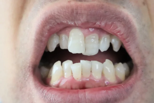 出っ歯の種類によってインビザラインGoの適否が大きく変わる理由